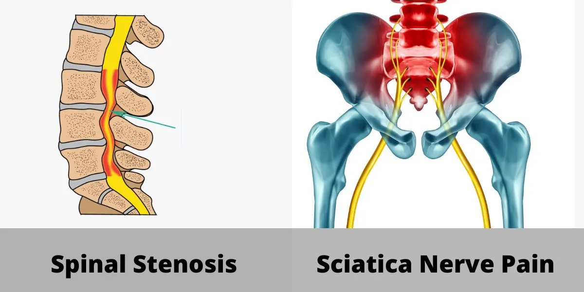 Sciatica Vs Spinal Stenosis
